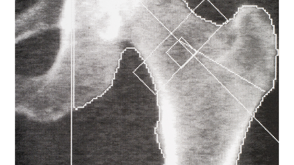 Best Bone Density Test Options For Osteoporosis