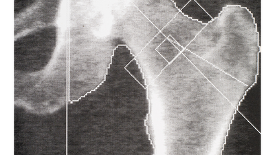 The Best Bone Density Tests For Osteoporosis