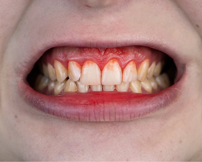 Periodontal gum disease.